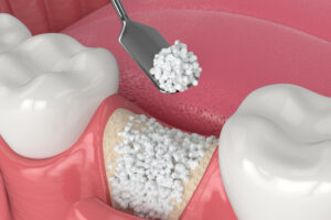 Illustration of dental bone grafting with bone biomaterial application.